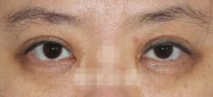 在成都做的雙眼皮修復(fù)案例，大家看看如何？