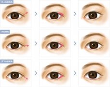 在北京開(kāi)眼角需要多少錢？