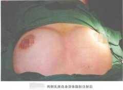 脂肪脂肪豐胸手術中護士的術中配合
