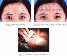 關(guān)于注射整形豐額頭的介紹！