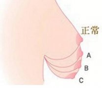 乳房下垂矯正手術(shù)中出現(xiàn)的形態(tài)異常應(yīng)該怎么辦