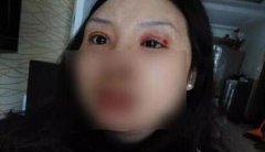爆料，張女士的雙眼皮是怎么了？