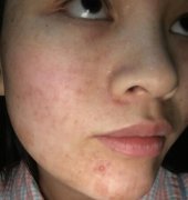 祛痘、去痘印果案例介紹