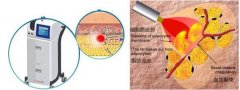 激光溶脂是如何進(jìn)行的？原理是什么？