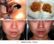 頰脂墊取出整形手術(shù)是怎樣的呢？