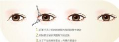 開內(nèi)眼角手術是如何進行的呢？注意事項？