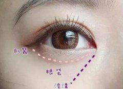 這三個“溝”在你眼睛旁邊，別小看了！