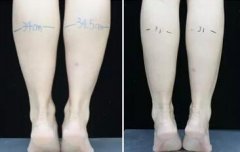 注射注射瘦腿果怎么樣？哪種品牌好？