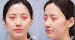 面部微整形的魅力到底有多大