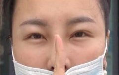 花費(fèi)數(shù)萬整容造成歪鼻梁 醫(yī)院稱：不滿足退款條