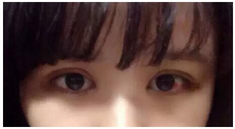 做了雙眼皮+開眼角，我也是萌妹子了!