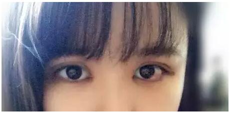 做了雙眼皮+開眼角，我也是萌妹子了!