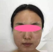 做了下頜角接骨整形技術(shù)之后，臉型真的是小了