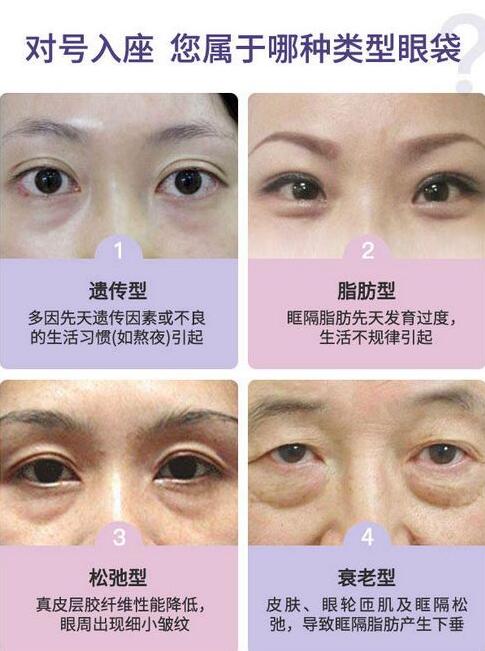 眼袋的種類