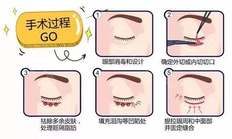 眶格釋放去眼袋