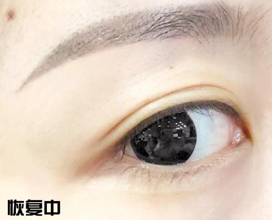 半******紋眉恢復(fù)期圖片