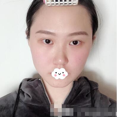 亞韓整形美容醫(yī)院隆鼻案例圖