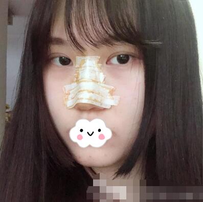 亞韓整形美容醫(yī)院隆鼻案例圖