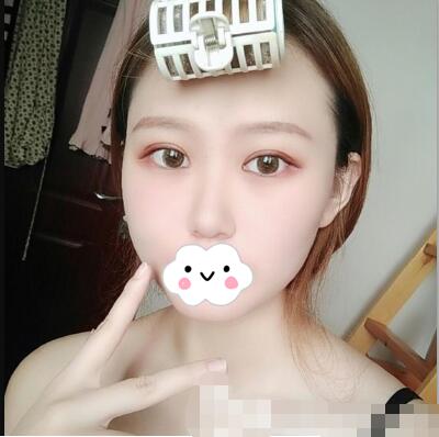 亞韓整形美容醫(yī)院隆鼻案例圖