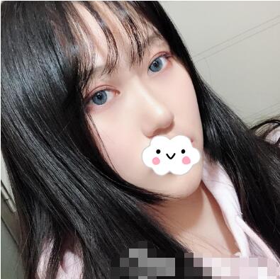 亞韓整形美容醫(yī)院隆鼻案例圖