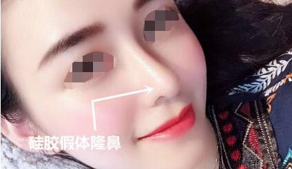 做隆鼻手術(shù)應(yīng)當(dāng)防止的幾個坑!