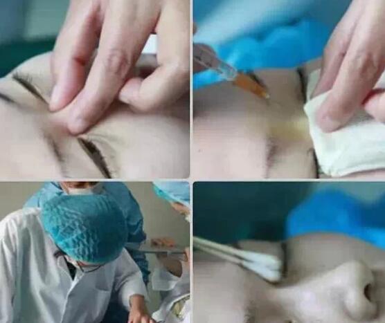 可以自己操作注射隆鼻嗎?