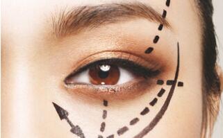 關于自體脂肪填充淚溝恢復期注意事項的那些事兒