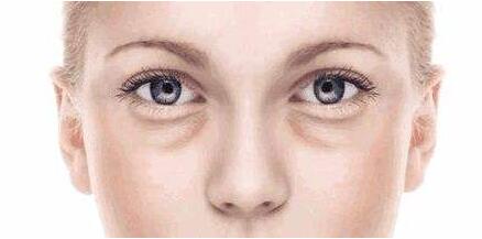 自體脂肪填充淚溝恢復期有哪些注意事項?