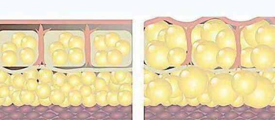 關于自體脂肪填充的一些疑問解答