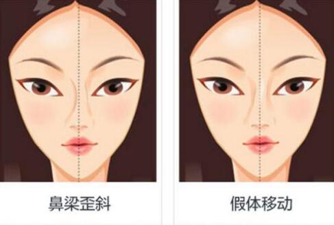 假體隆鼻手術(shù)失敗很常見