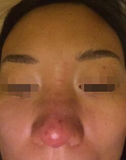 硅膠隆鼻假體明X有什么補(bǔ)救措施嗎?