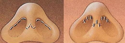 鼻整形手術(shù)的創(chuàng)口挑選