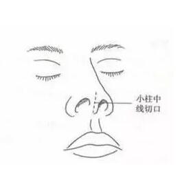 鼻整形手術(shù)的創(chuàng)口挑選