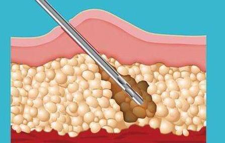 自體脂肪填充術(shù)后如何護(hù)理?
