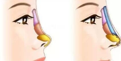 　膨體隆鼻假體取出后對(duì)比差別會(huì)不會(huì)很大呢?