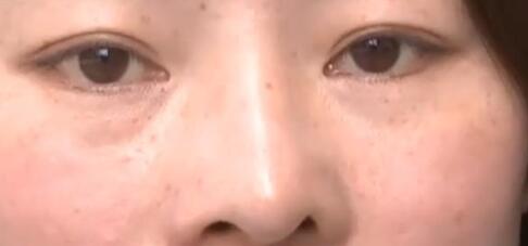 隆鼻術(shù)后，為什么會(huì)出現(xiàn)鼻子假體挪動(dòng)、傾斜?