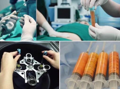 自體脂肪的成活率大約多少錢?