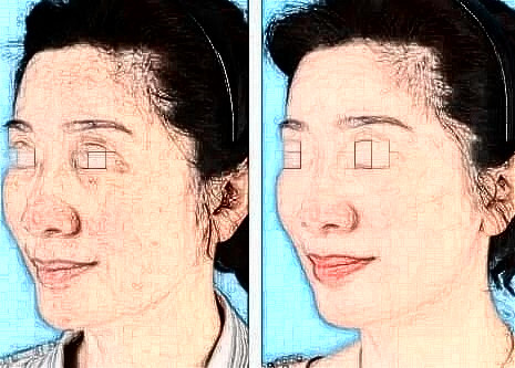 自體脂肪的成活率大約多少錢?