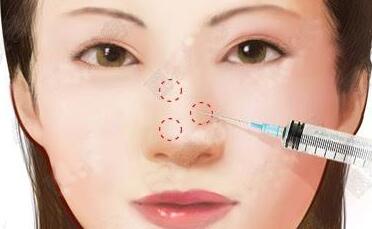 注射隆鼻有什么危害？值得大家做嗎？