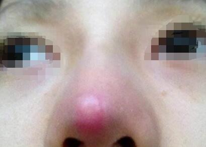 注射隆鼻有什么危害?