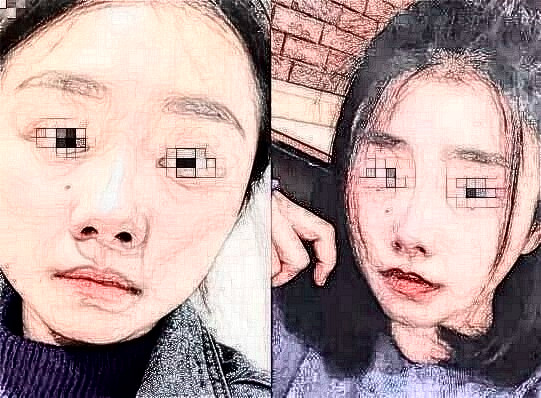 自體脂肪臉部后臉會增大?