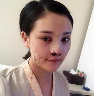 隆鼻術(shù)后的恢復(fù)期過程以及注意事項