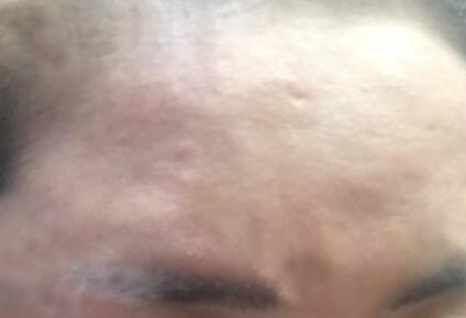 自體脂肪填充臉頰有風險嗎?