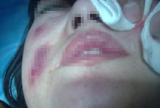 自體脂肪填充臉頰有風險嗎?