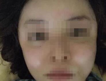 自體脂肪填充臉頰有風險嗎?