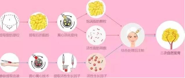 脂肪隆鼻術(shù)的果是怎樣的?