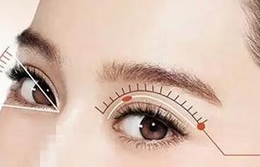 埋線雙眼皮和全切雙眼皮該怎么選擇?
