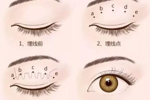 埋線雙眼皮和全切雙眼皮該怎么選擇?