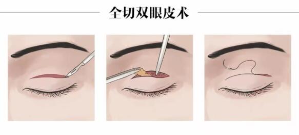 埋線雙眼皮和全切雙眼皮該怎么選擇?