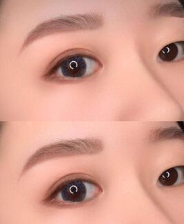 全切雙眼皮適宜人群